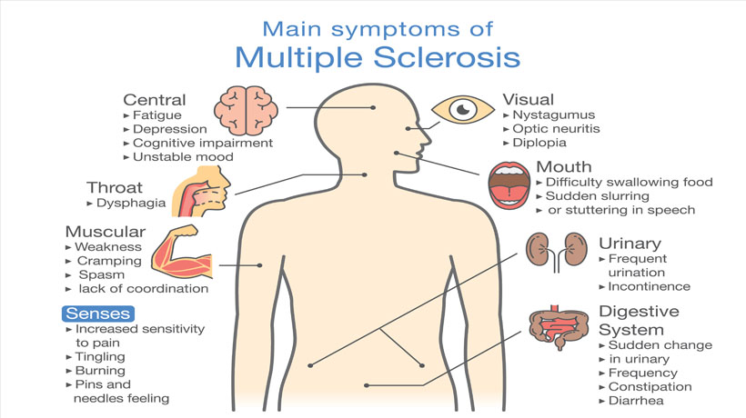 Image result for Common Symptoms of Multiple Sclerosis (MS)