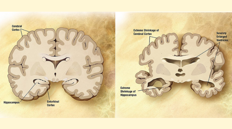 Alzheimer’s and its link to cleaning system of brain cells