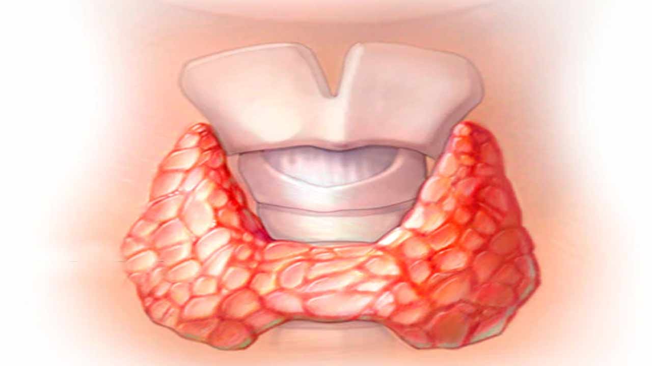 hypothyroidism