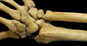 Breakthrough Discovery May Speed Up Bone Implant Recovery 