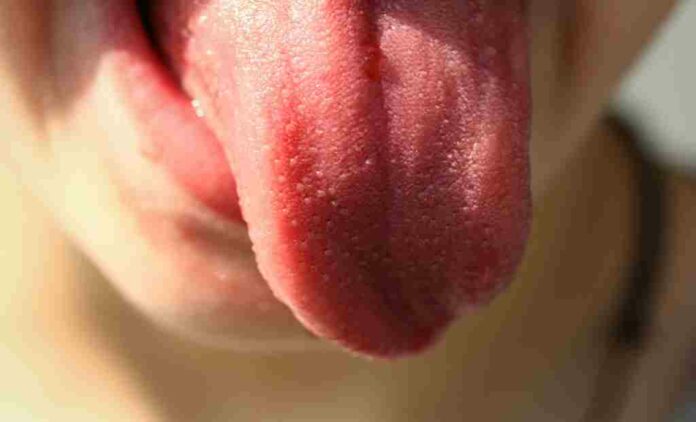 Covid tongue is small bumps or swellings on the surface of the tongue.