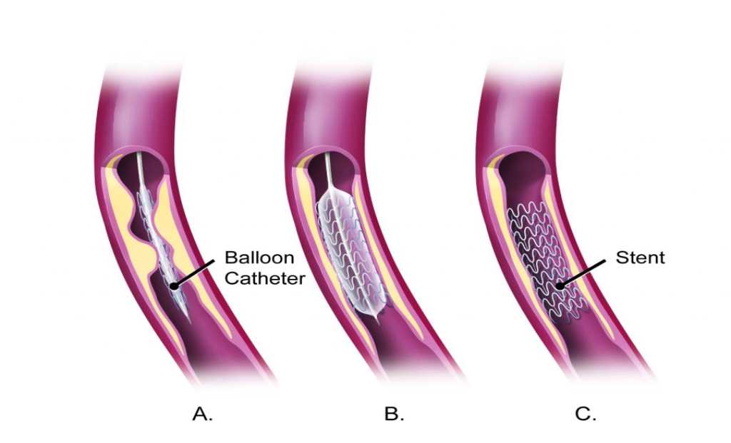 In the term angioplasty, angio means blood vessel and plasty is the process of opening up.