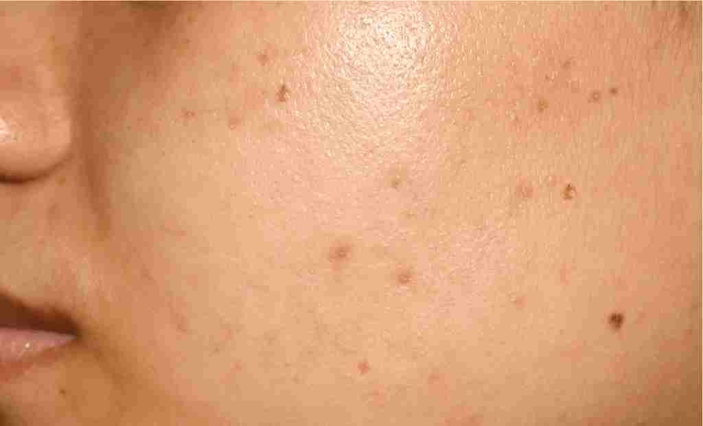Hyperpigmentation: Root Cause, Preventive Measures And Solutions