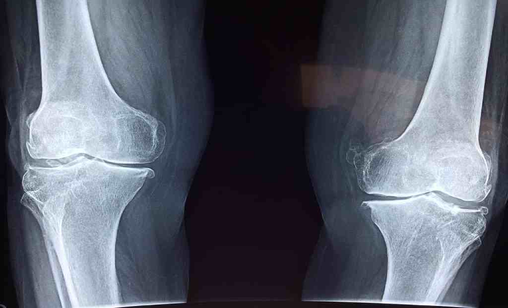 Advantages of Robotic Knee Replacement Surgery: Expert Insights on Precision and Faster Recovery