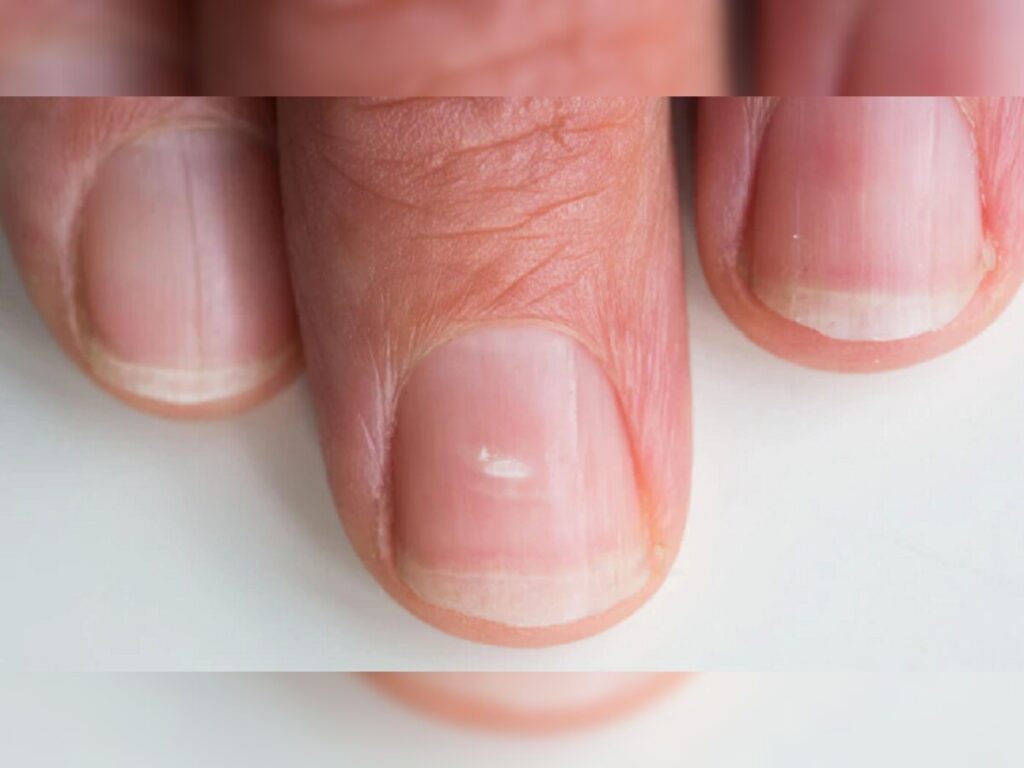 Anemia nails: Appearance, causes, and treatments