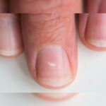 Pale Nails Due To Vitamin B12 Deficiency
