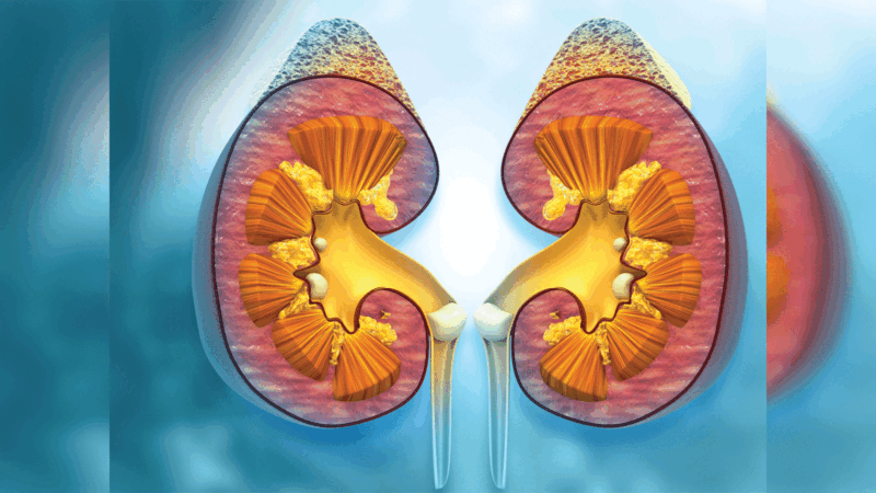 Kidney Stone Home Remedies: 5 Tips To Get Rid of Stones Inside The Kidney Naturally Without Operation