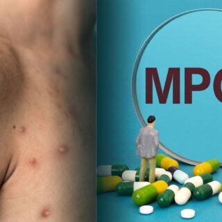 Mpox Health Insurance