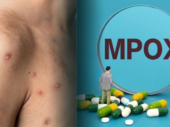 Mpox Health Insurance